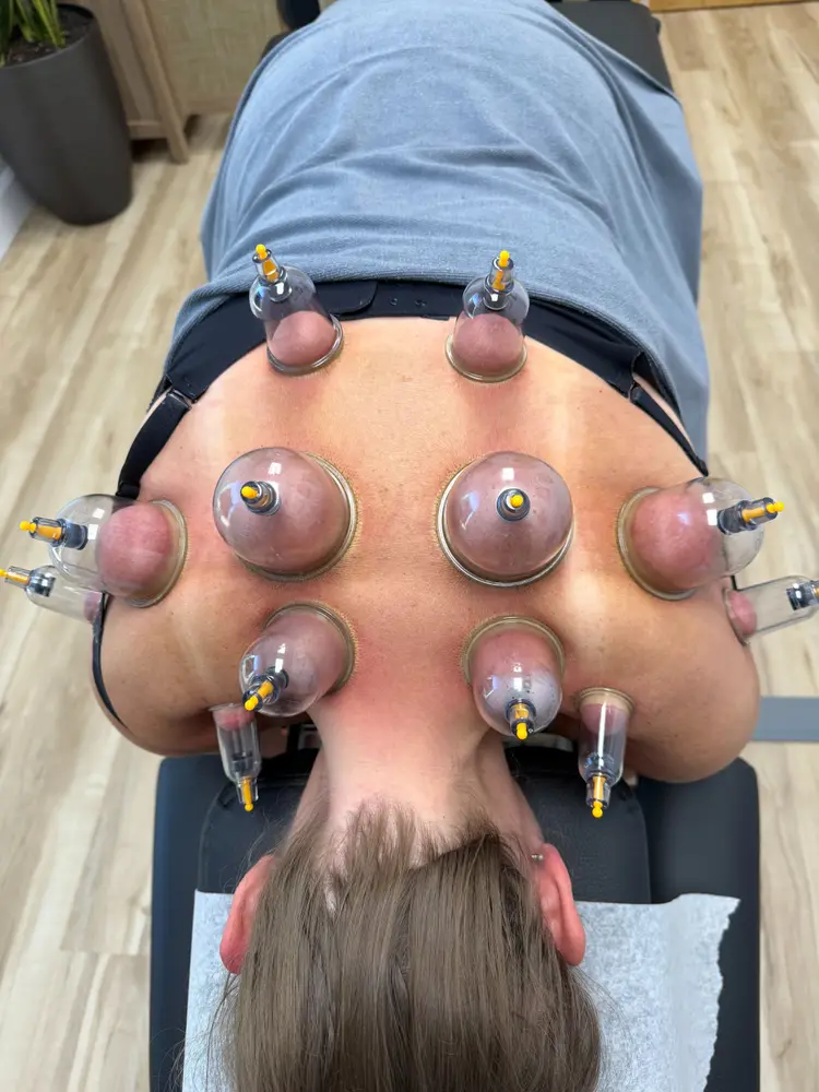 Cupping therapy applied across a patient’s back